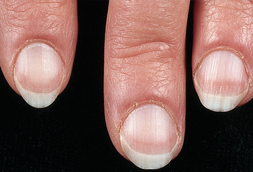 nails and disease