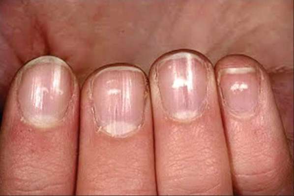 White Spots On Your Nails...? Here is What They Indicate!
