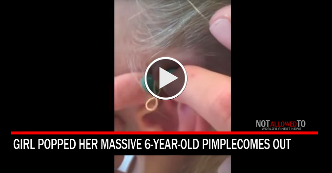 pimple popped